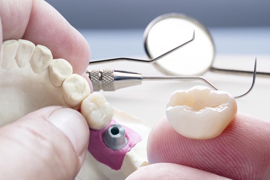 closeup prosthodontics or prosthetic single teeth crown and bridge equipment model express fix restoration1